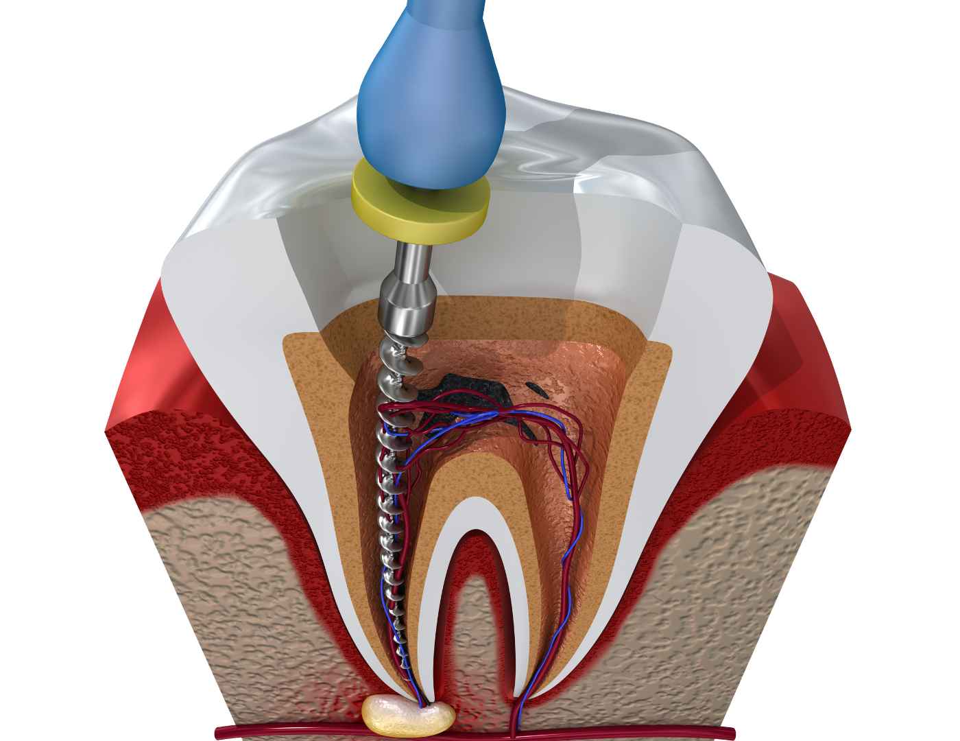 Root Canal