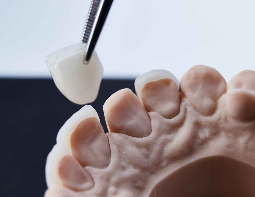 Traditional Veneers vs. Composite Veneers Armadale Dental