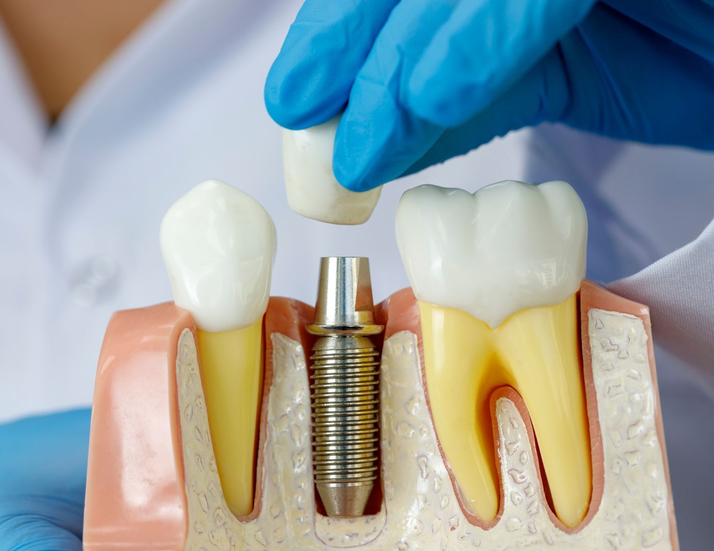 Dental Implant Healing Stages