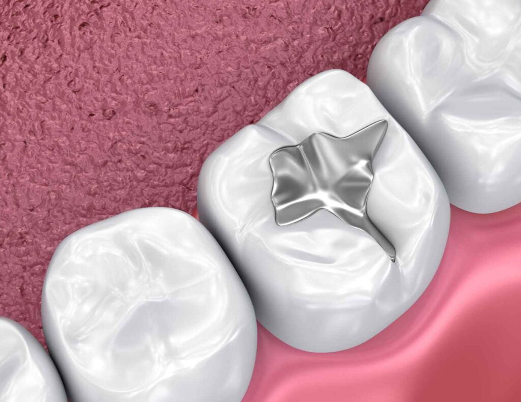 Understanding Temporary Tooth Fillings When and How to Care for Them