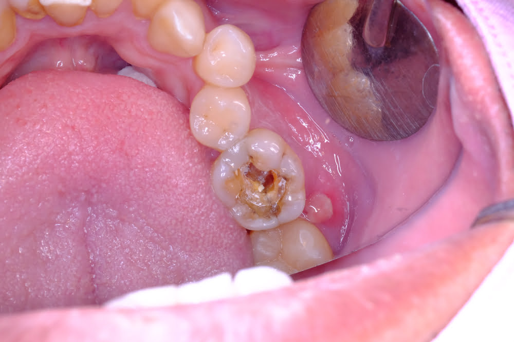 Cracked tooth root canal