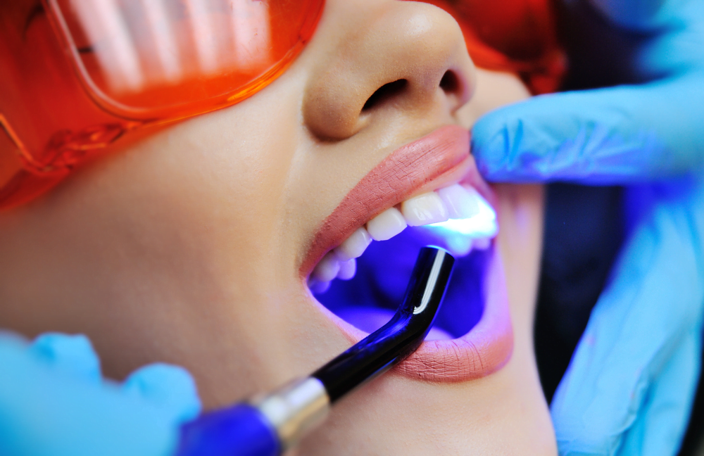 Laser teeth Whitening