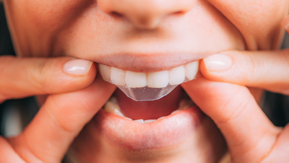 are teeth whitening strips bad for you