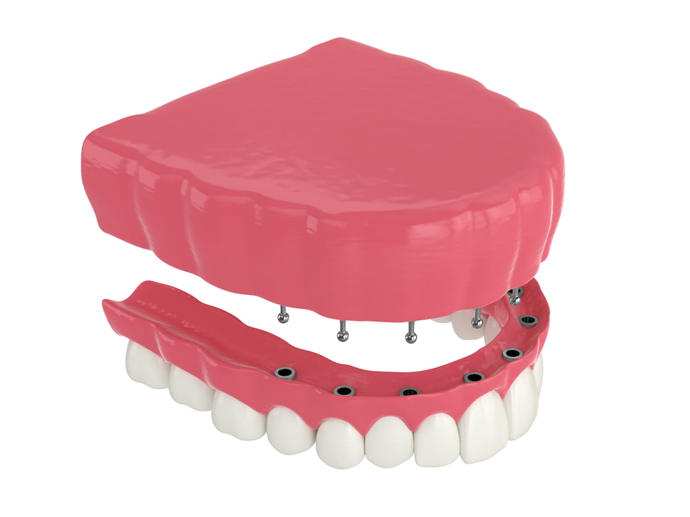 problems with snap-in dentures