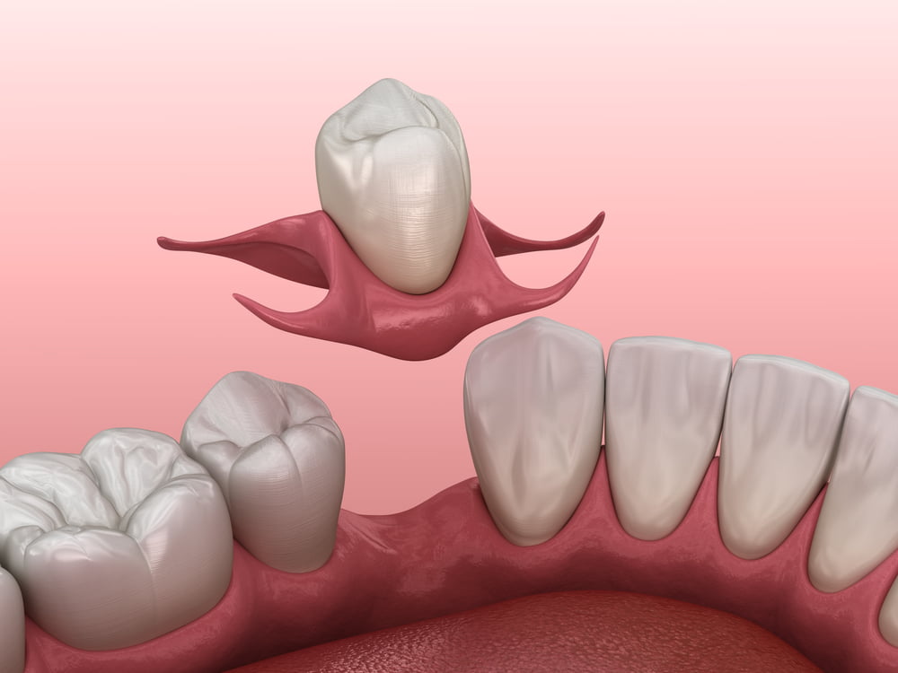 single tooth partial denture