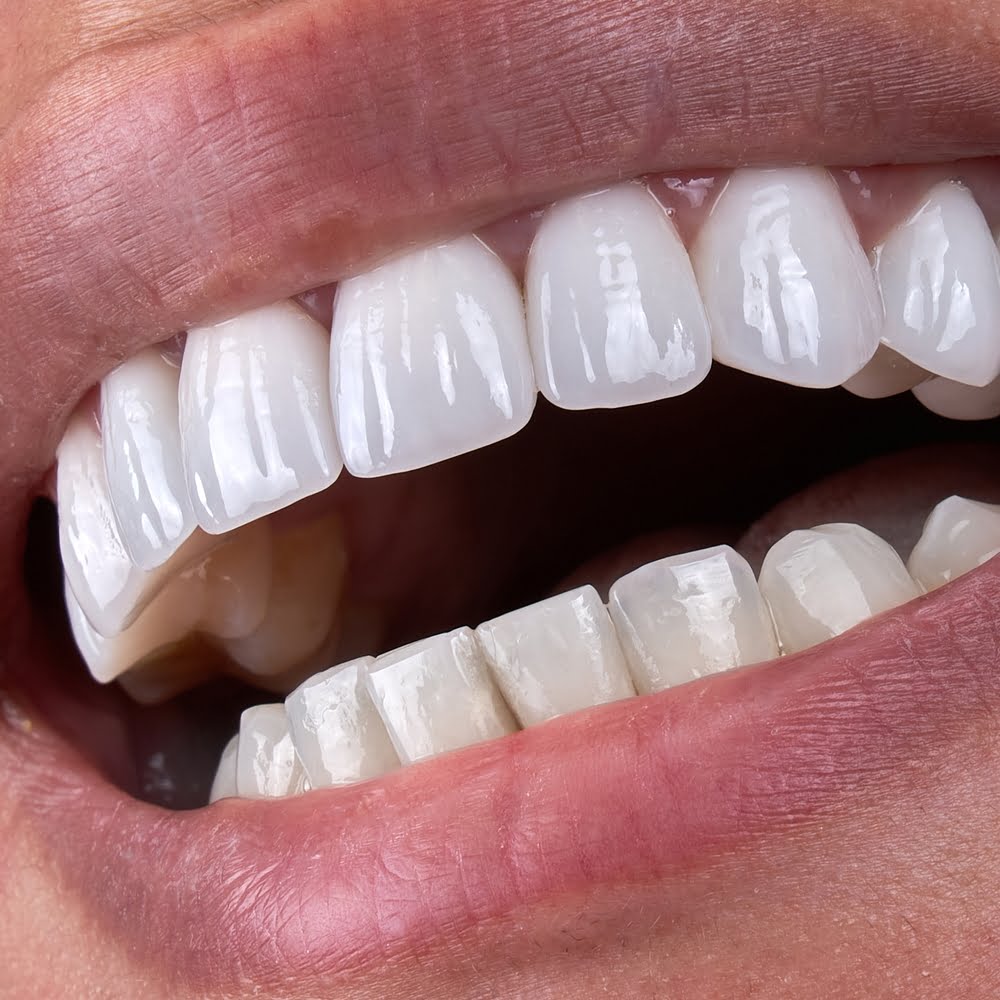 teeth whitening Toronto