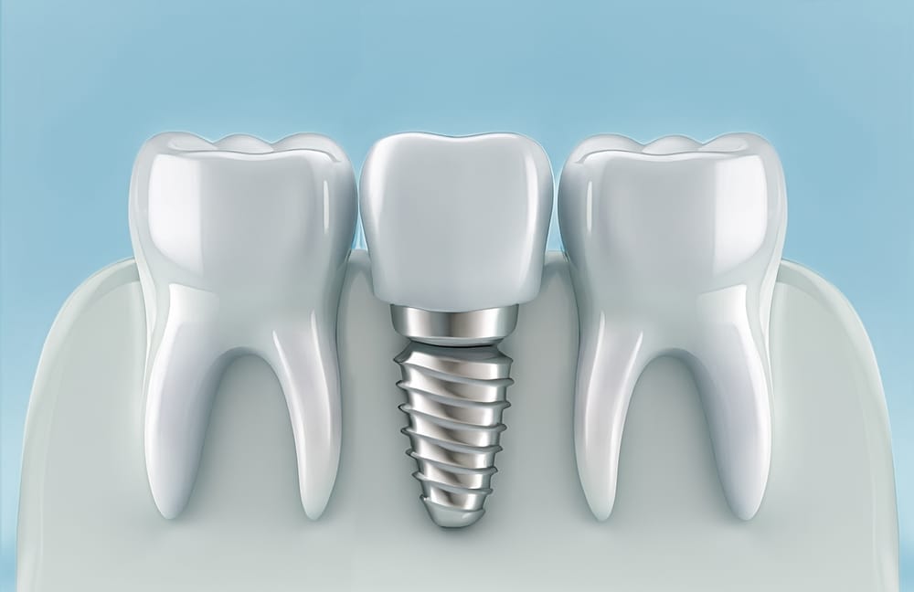 dental implants cost in Canada