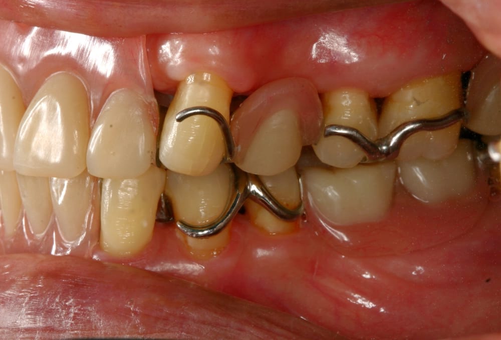 partial dentures for back teeth on one side