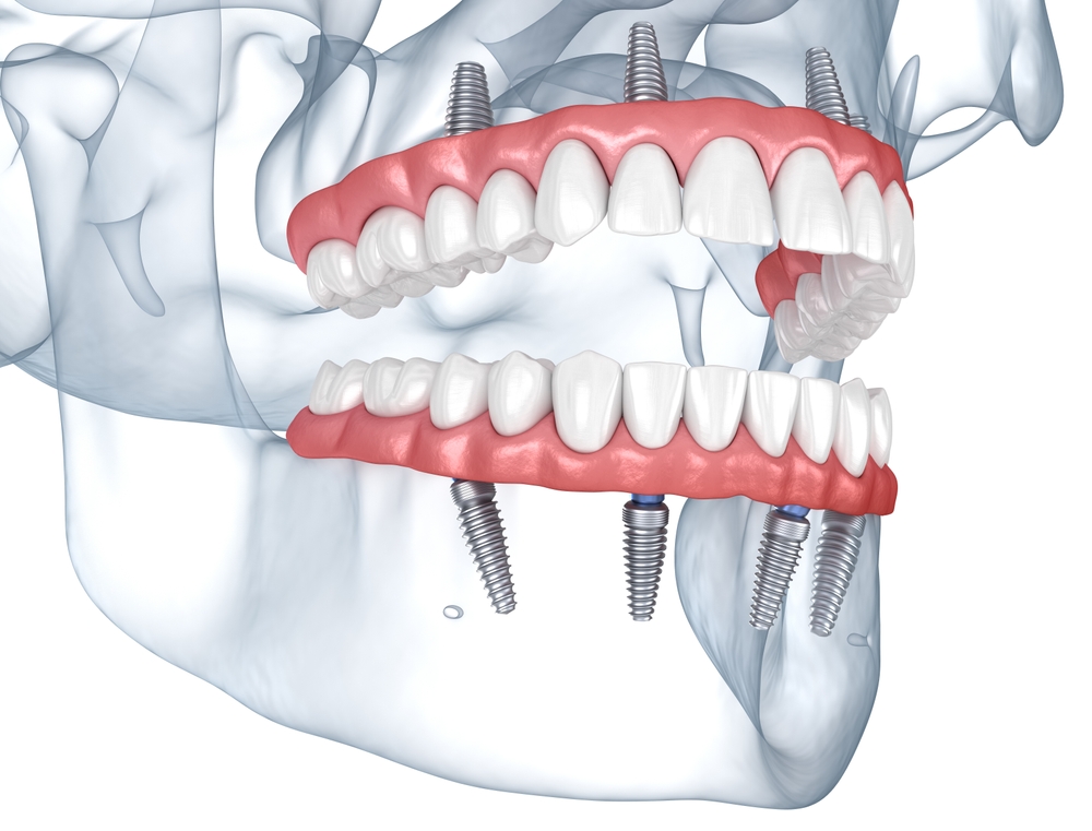 all on 4 dental implants