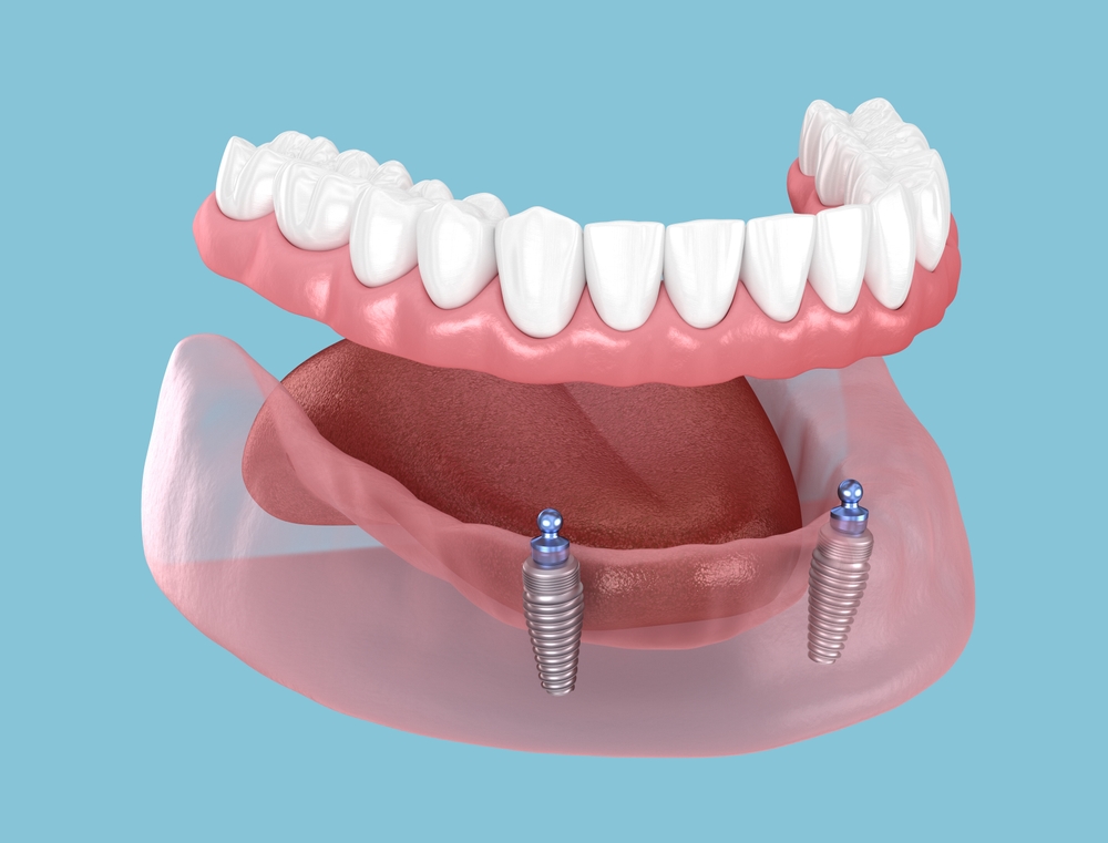 before and after dentures