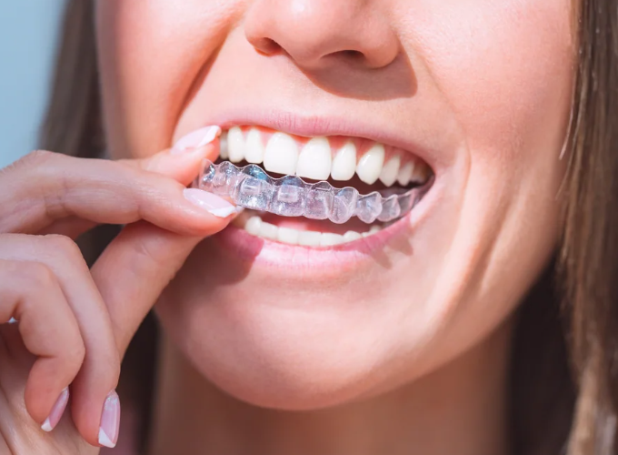 Clear Aligners