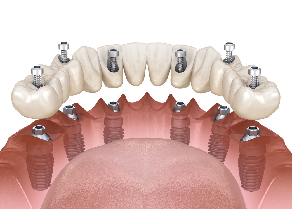 lower denture implants