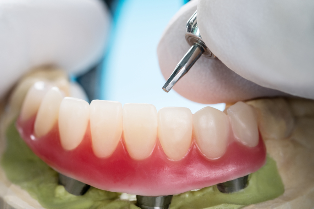 upper denture implants