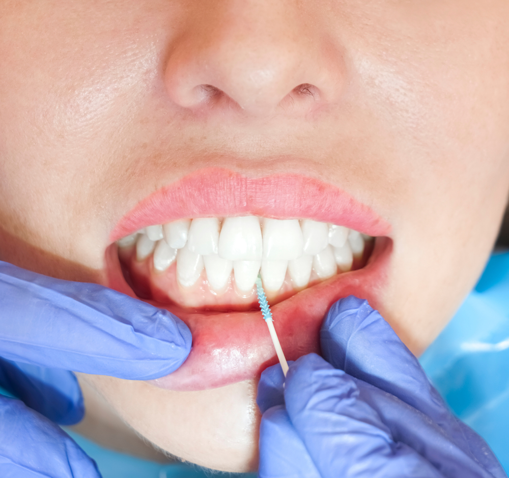 Expert from Teeth Cleaning in Markham